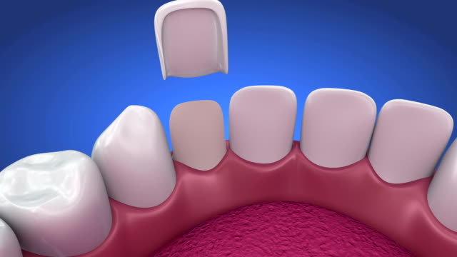 Dental Veneers: Porcelain Veneer installation Procedure. 3d animation